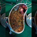 gallbladder, Stones, operation