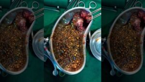 gallbladder, Stones, operation