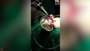 gallbladder, Stones, operation