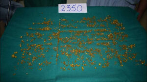 gallbladder, Stones, operation